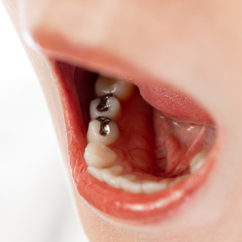 歯の治療歴が増える・劣化する