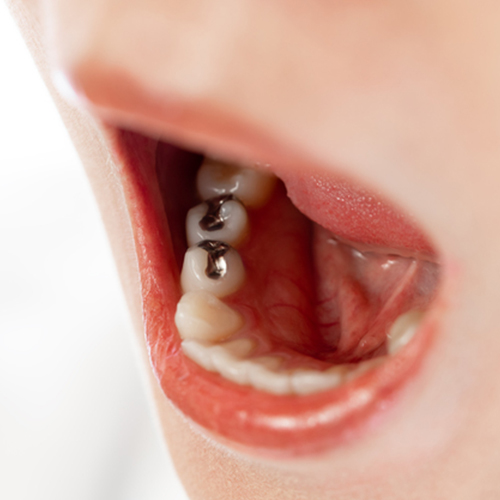 虫歯・治療痕の劣化